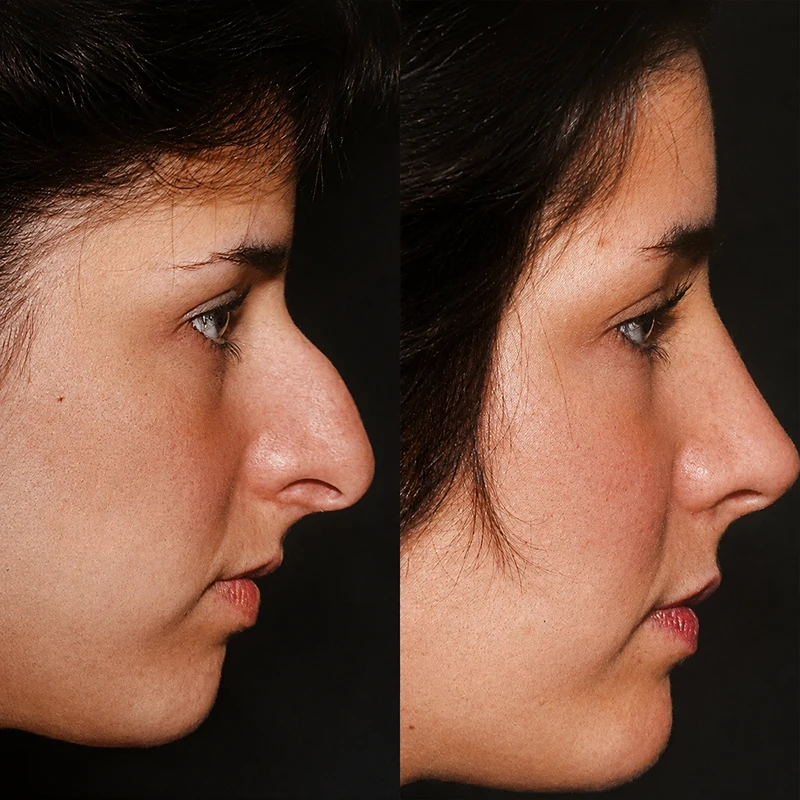 Rhinoplasty before and after profile balancing female patient NJ