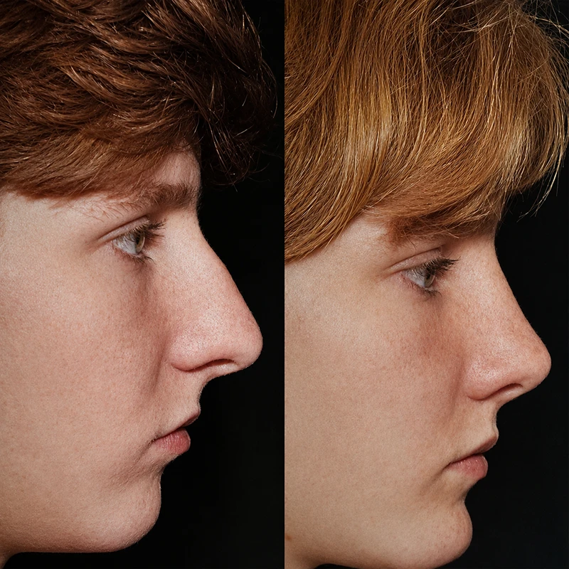Rhinoplasty before and after male patient bridge and tip refinement West Orange NJ
