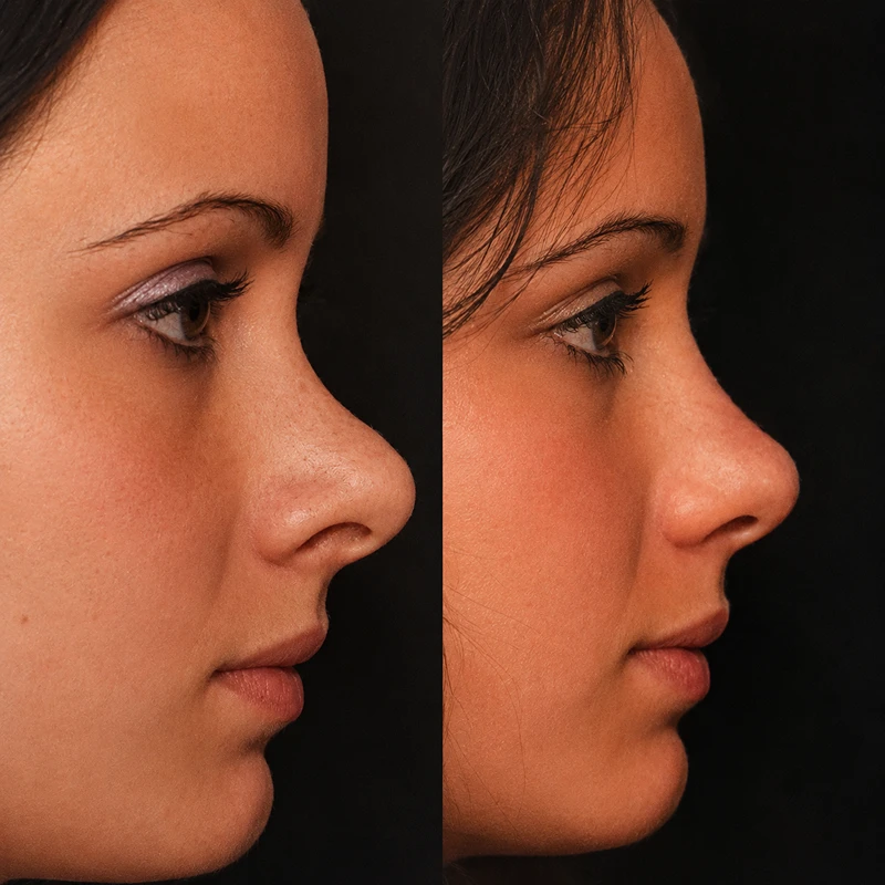 Rhinoplasty before and after tip refinement smiling patient West Orange